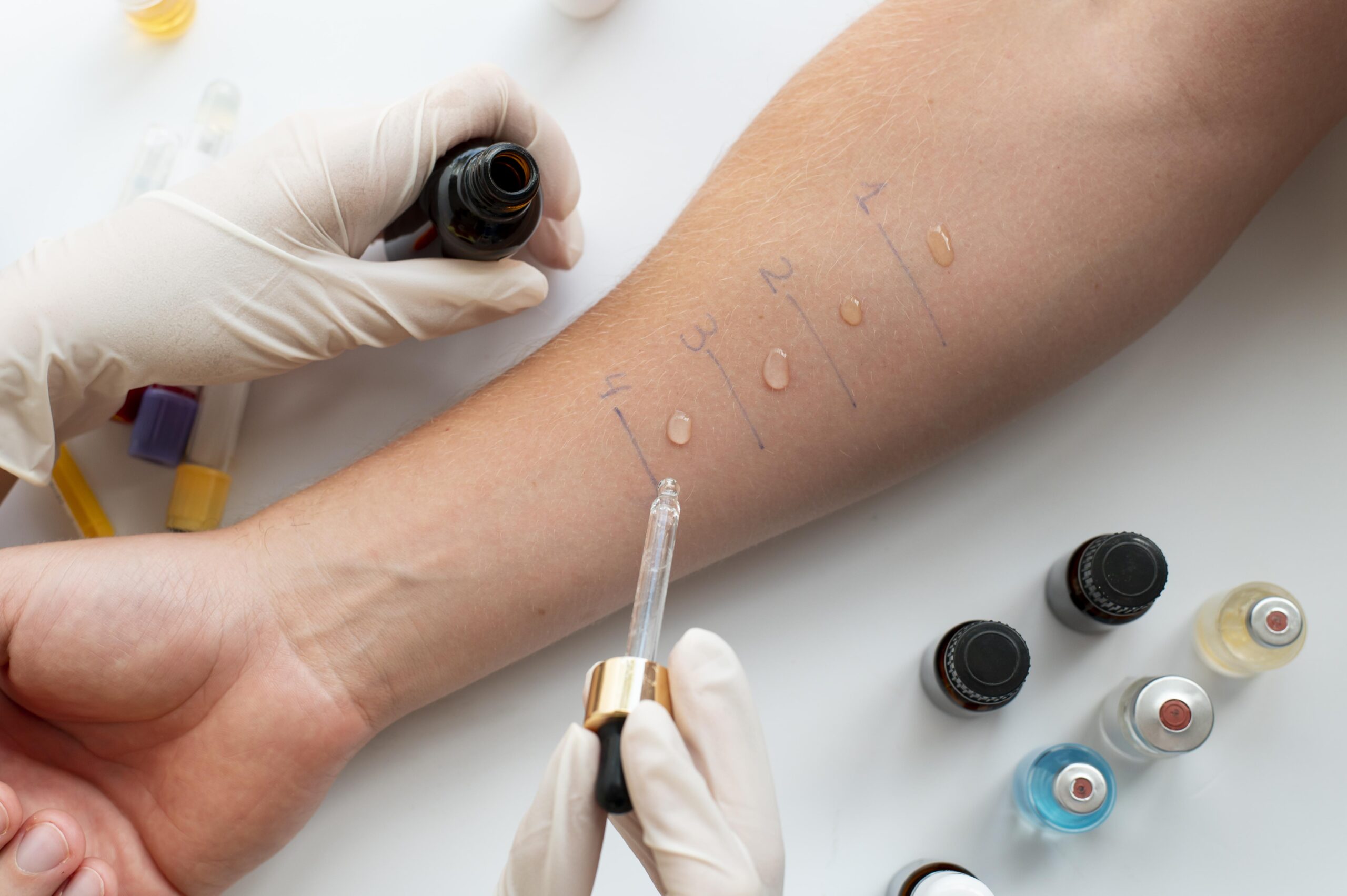 Test de alergia Prick en brazo de paciente